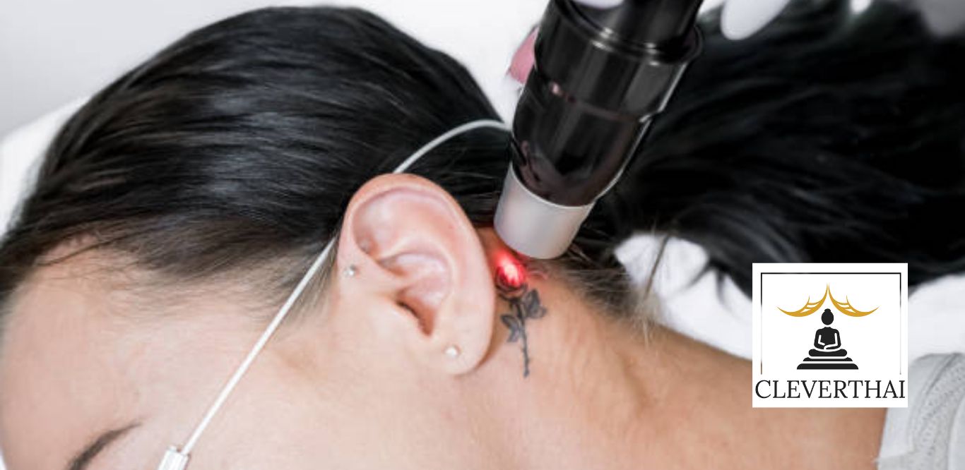 Top 5 Clinics for Tattoo Removal in Bangkok